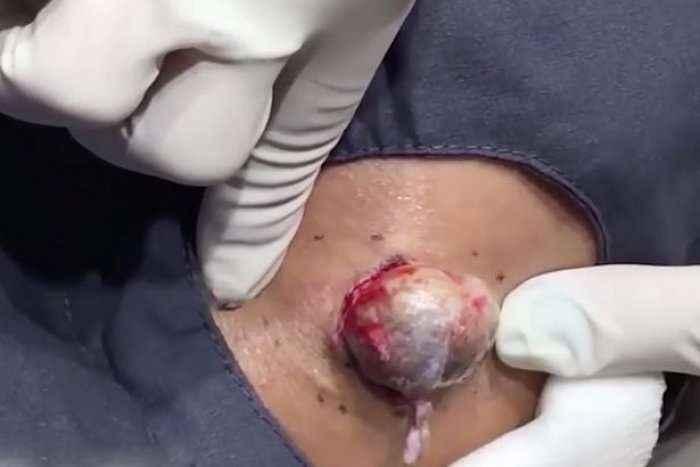 Doktoresha i shtrydh një cist sa një kokërr veze (Video +18)