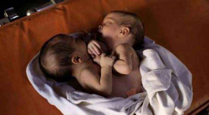 Vdesin binjakët siamezë në Siri - regjimi s'i la të dilnin jashtë vendit për t'u operuar