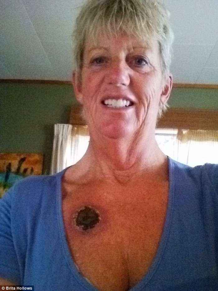 Gruaja pretendon se shëroi kancerin e lëkurës me melhem të zi 