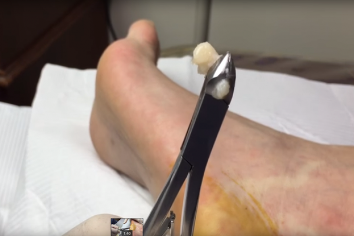 E tmerrshme: Ja çfarë nxjerr nga këmba e pacientit ky mjek (Video)