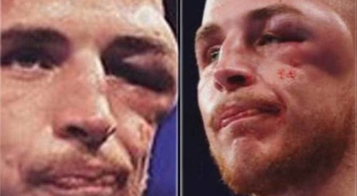 Lëndimi i syrit që e tronditi botën e boksit