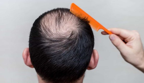 ​Rënia e flokëve mund të jetë shenjë e një sëmundjeje të rëndë