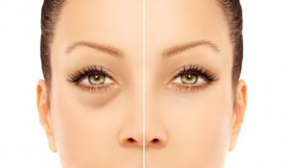 5 trajtimet e panjohura që duhet t’i provoni sa më parë nëse vuani nga rrathët e errët nën sy