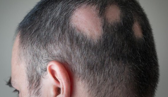 Rënia e flokëve ndikon në shëndetin tuaj mendor