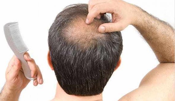 Ekspertët tregojnë se çka e shkakton rënien e flokëve te burrat