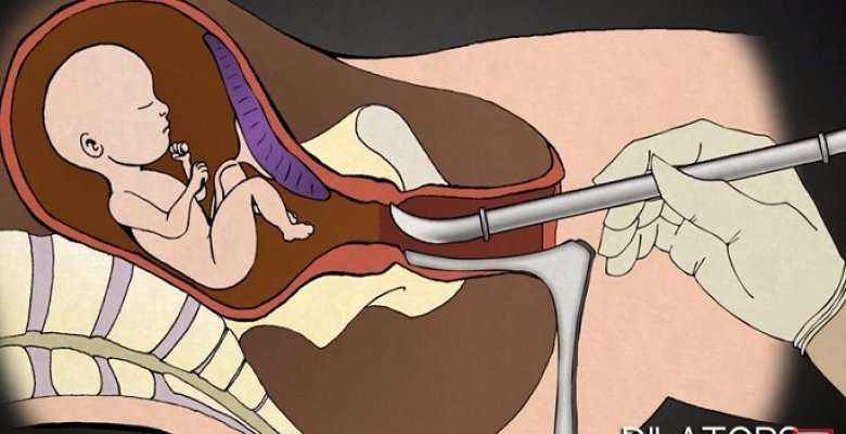 Ja çfarë ndodh me beben gjatë abortimit (Video)