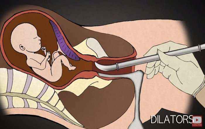 Ja çfarë ndodh me beben gjatë abortimit (Video)
