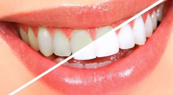 Si të keni dhëmbë të bardhë si bora?