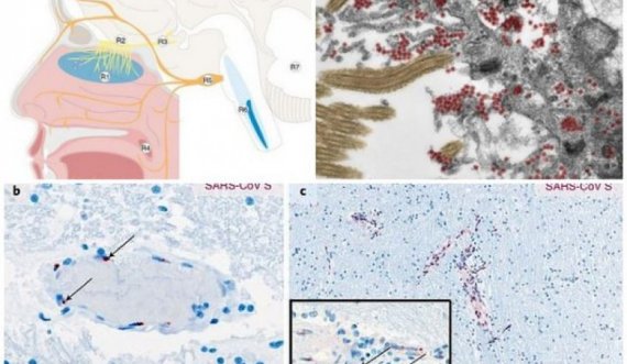 Përmes hundës dhe enëve të gjakut/ Studimi gjerman: Si futet koronavirusi në tru, pasojat e rënda tek pacientët