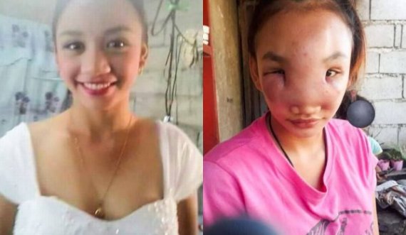 17-vjeçarja shtrydh puçrrën pastaj i shfaqet sëmundja misterioze në fytyrë