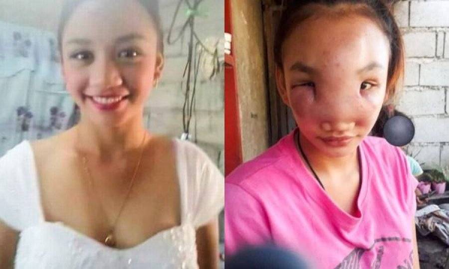 17-vjeçarja shtrydh puçrrën pastaj i shfaqet sëmundja misterioze në fytyrë