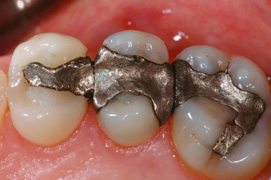 Cili është ndikimi i mbushjeve të zeza të dhëmbëve në organizëm?