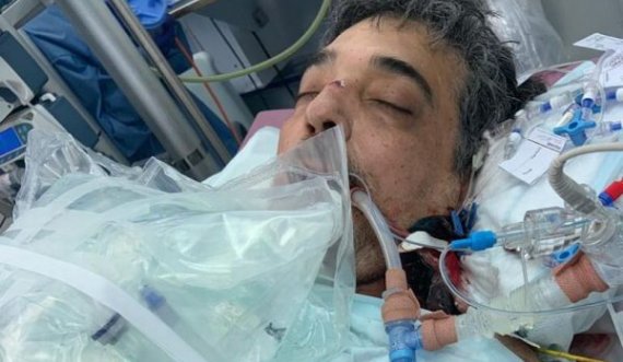 Flet 57-vjeçari i cili mundi koronavirusin pas 222 ditësh në spital