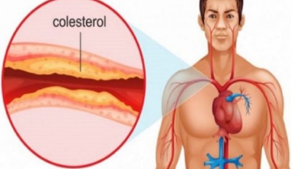 Simptomat e kolesterolit të lartë që nuk duhen neglizhuar