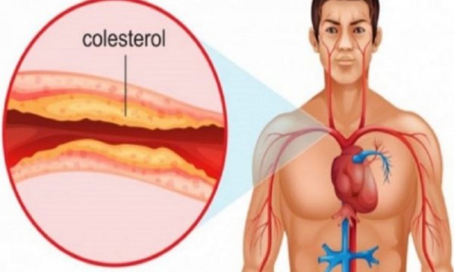 A duhet t’i kontrolloni rregullisht nivelet e kolesterolit?