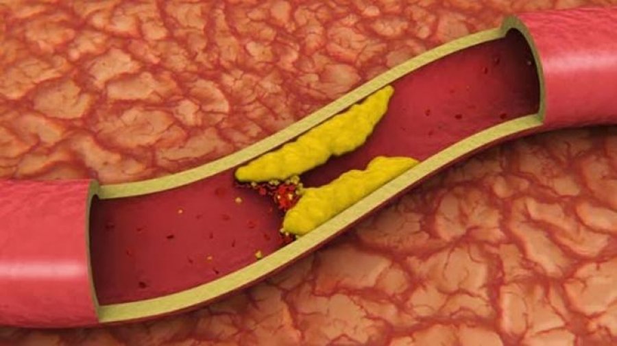 Si ta shëroni kolestelorin e grumbulluar në enët e gjakut brenda 40 ditësh