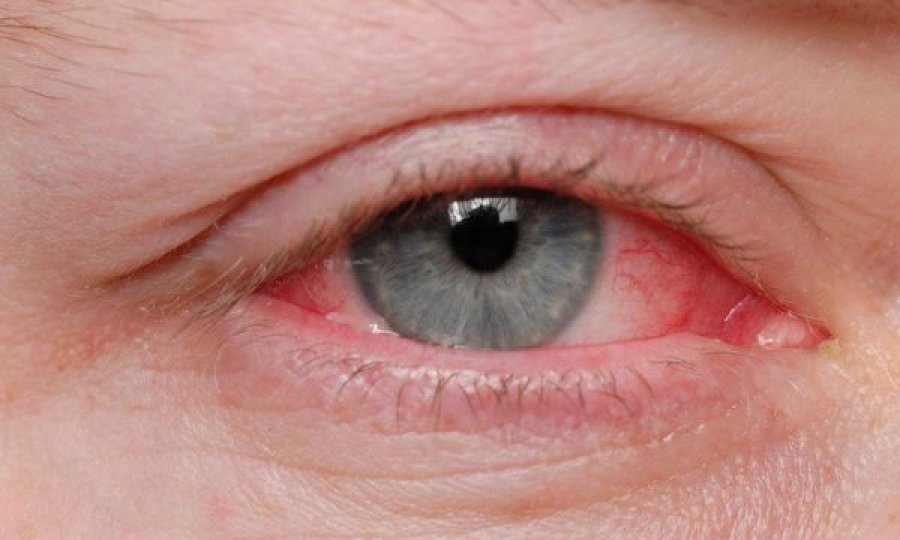 Simptomat e koronavirusit tek sytë, a mund të përhapet edhe nga lotët?
