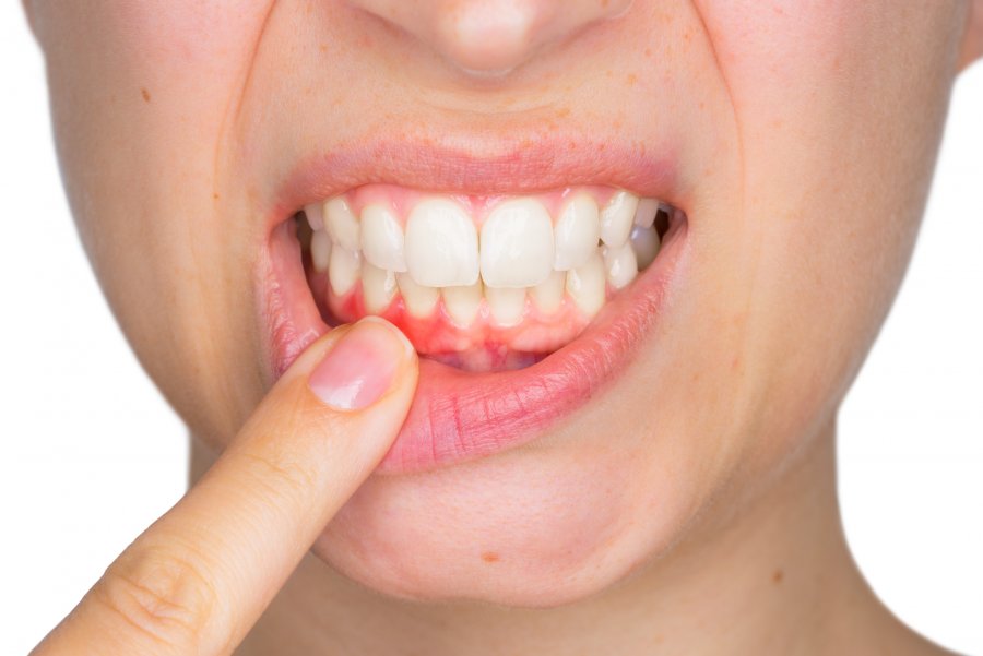 Inflamacioni dhe gjakderdhja e mishit të dhëmbëve