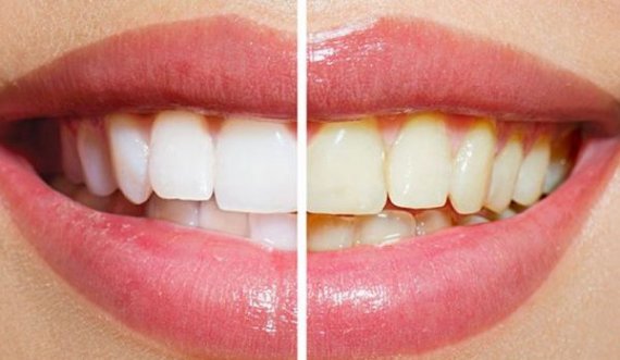 Zbardhja e dhëmbëve me dy përbërës – e garantuar në më pak se 2 minuta!