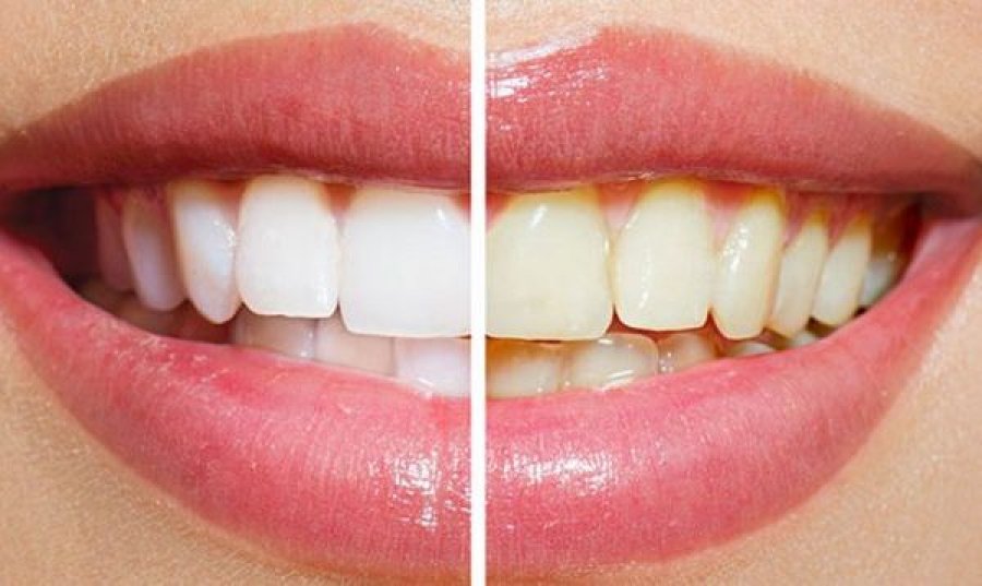 Zbardhja e dhëmbëve me dy përbërës – e garantuar në më pak se 2 minuta!