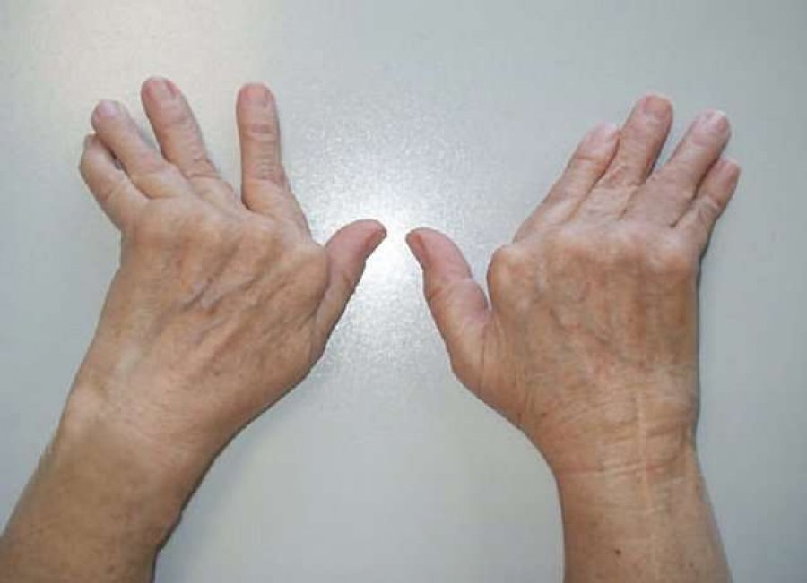 Metodë e re për diagnostikimin e artritit
