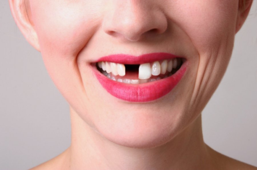 A mund të shkaktojë Covid-19 edhe rënien e dhëmbëve? 