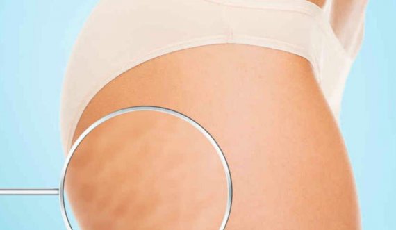 Pesë sekretet e dermatologëve si të zhdukni celulitin në pak kohë! Ja ç’duhet të bëni