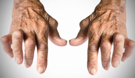 Artriti nuk është vetëm sëmundje e të moshuarve