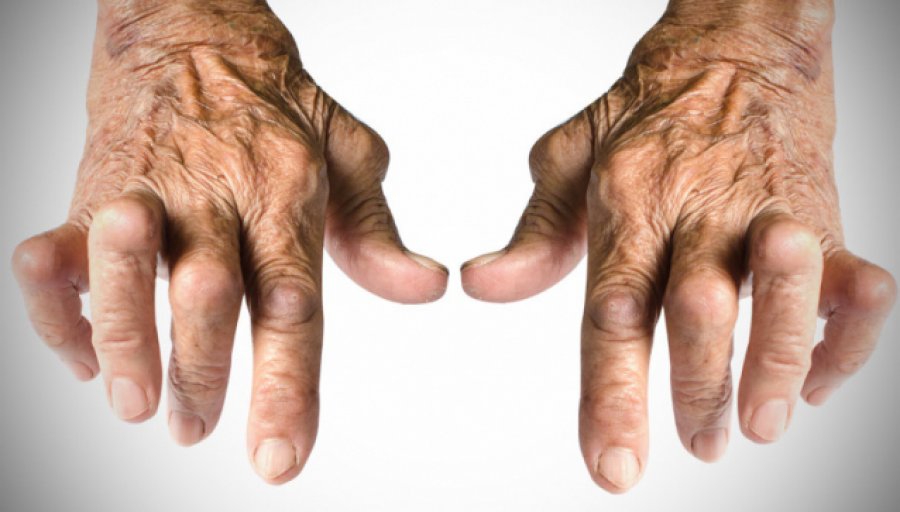 Artriti nuk është vetëm sëmundje e të moshuarve