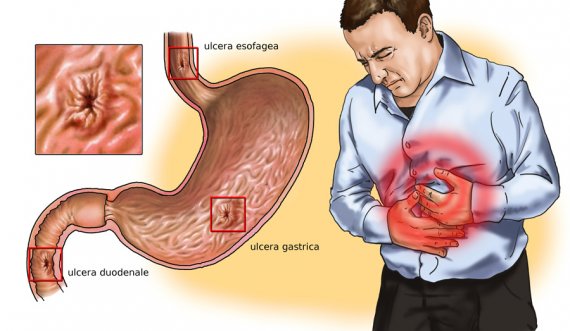 Shenjat paralajmëruese të ulcerës 