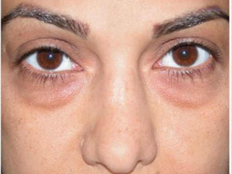 Mënyrat më të përshtatshme për reduktimin e ënjtjes së lëkurës përreth syve