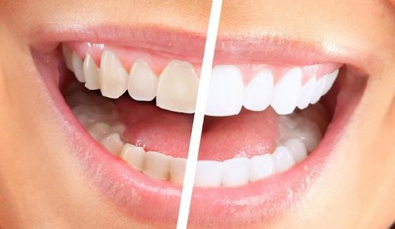 Bëni dhëmbët më të bardhë në shtëpi në vetëm 3 minuta. 100% efikasitet i vërtetuar