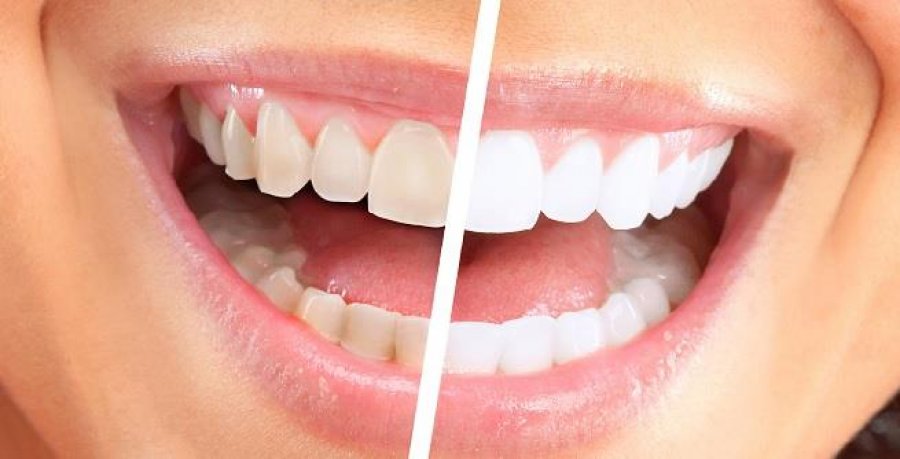Bëni dhëmbët më të bardhë në shtëpi në vetëm 3 minuta. 100% efikasitet i vërtetuar