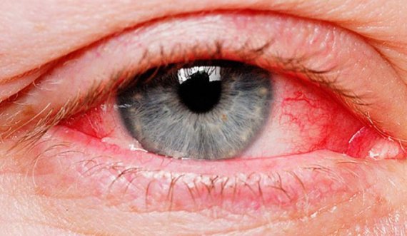 Sytë e kuq ju paralajmërojnë për sëmundjen e rëndë