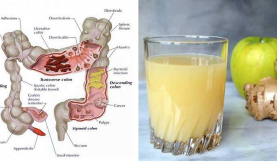Pjesa më e madhe vuajnë nga kapsëllëku, me këtë recetë do e pastroni zorrën e trashë dhe do hiqni 5 kile nga trupi