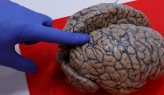 Koronavirusi mund të depërtojë në tru dhe të rrisë rrezikun e sëmundjes së Parkinsonit