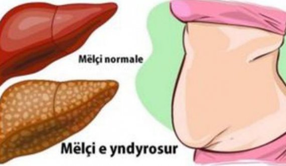 Nga kjo sëmundje vuan 1 në 5 persona pa e ditur, ja si ta kuptoni dhe kjo është kura për një shëtim të plotë