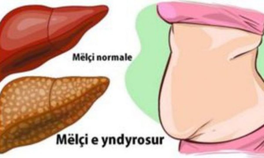 Nga kjo sëmundje vuan 1 në 5 persona pa e ditur, ja si ta kuptoni dhe kjo është kura për një shëtim të plotë