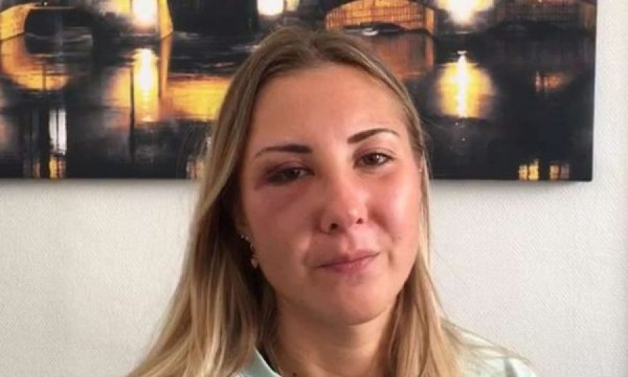 Studentja quhet prostitutë dhe grushtohet në fytyrë nga tre burra – se kishte veshur minifund