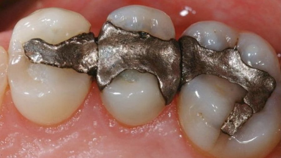 Cili është ndikimi i mbushjeve të zeza të dhëmbëve në organizëm?