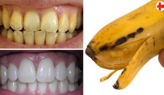 Pastroni dhëmbët me dredhëza dhe lëvore të bananes, shmangeni shpëlarjen me vaj kokosi!