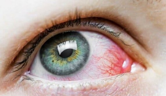 Njollat e kuqe në sy: Pse shkaktohen dhe a janë të rrezikshme