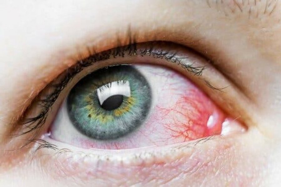 Njollat e kuqe në sy: Pse shkaktohen dhe a janë të rrezikshme