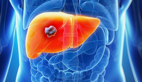 Hepatiti i pashëruar hap rrugën për kancer në mëlçi