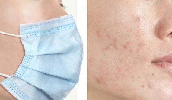 Dermatologët tregojnë pse mbajtja e maskës ju krijon puçrra 