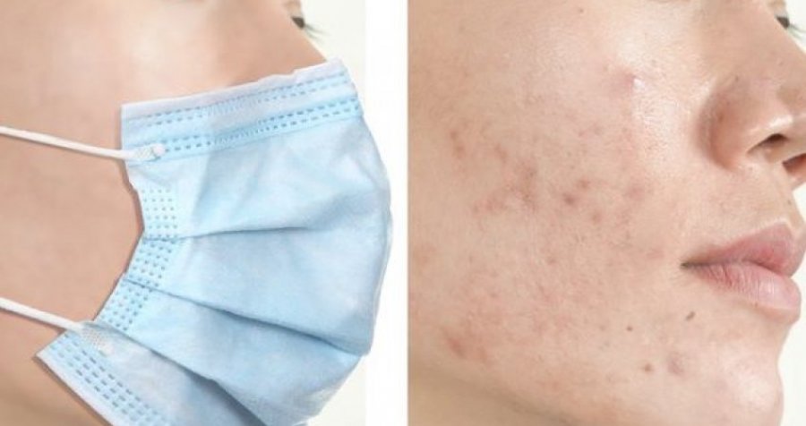 Dermatologët tregojnë pse mbajtja e maskës ju krijon puçrra 