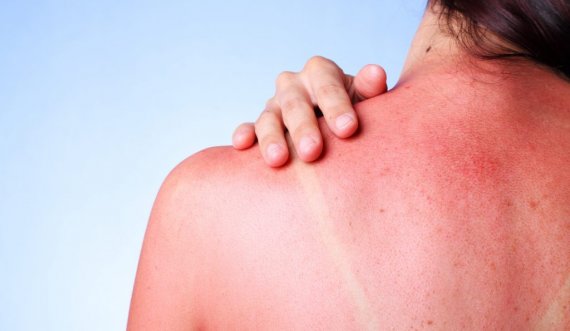 Kompresat e ftohta kundër alergjisë në diell