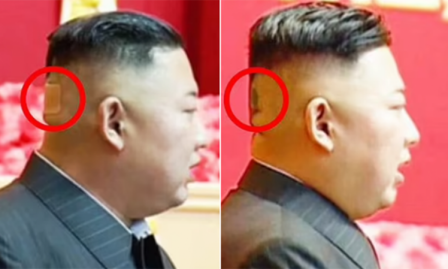  A është sëmurë? Kim Jong-un shfaqet me një njollë të zezë prapa koke 