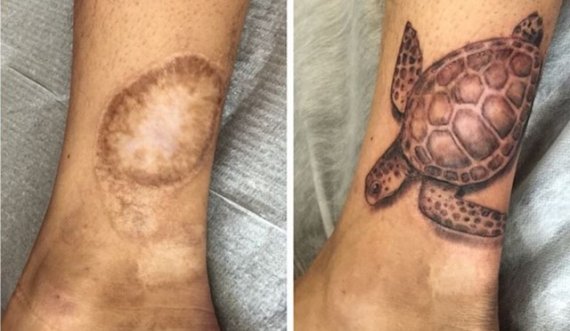 Rastet më interesante kur plagët mbulohen me tatuazhe