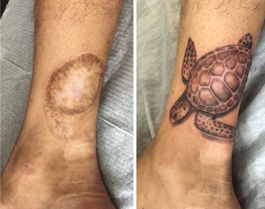 Rastet më interesante kur plagët mbulohen me tatuazhe